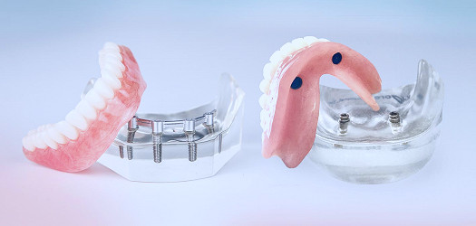 Implant Retained Dentures and Hybrid Restorations in Hopewell | Ellis  Family Dentistry